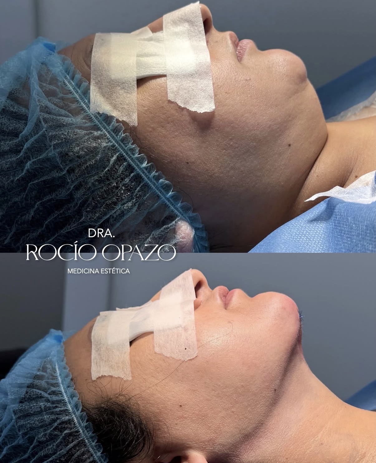 Lipopapada con Platimoplastía