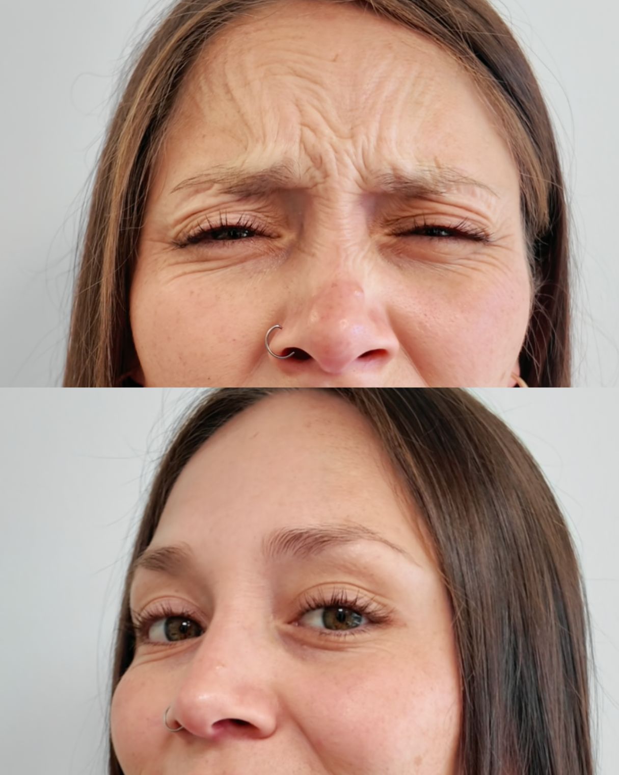 Bótox tercio superior 